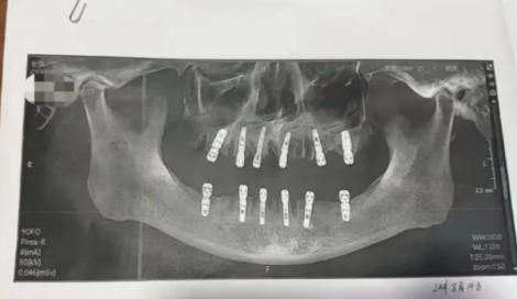 男子一天拔牙23顆！13天後死了　醫院竟說要提告